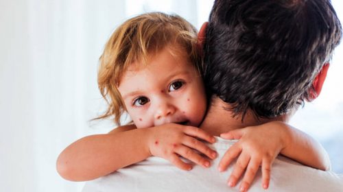 Προτίμησε τα εννέα παιδιά του να νοσήσουν με ανεμοβλογιά αντί να τα εμβολιάσει