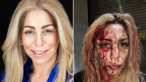 Χαμός σε μπαρ: Ξυλοκόπησαν άγρια γνωστή ηθοποιό επειδή ήταν… λευκή