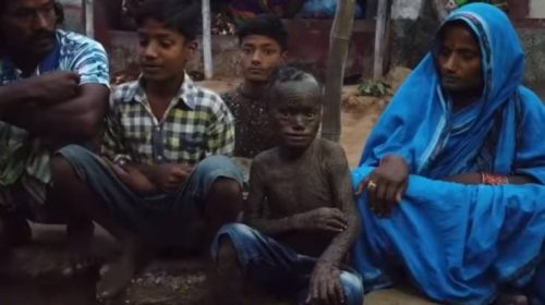 Δεκάχρονο αγόρι στην Ινδία με δέρμα φιδιού: Η σπάνια ασθένεια και οι σοκαριστικές εικόνες